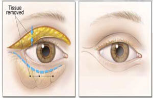 Blepharoplasty illustration