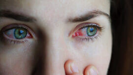 bloodshot eyes