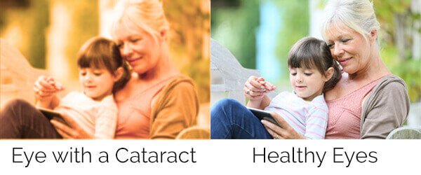 Cataract photo comparison