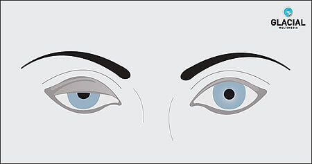 Illustration of ptosis